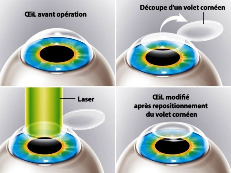 LASIK-இன் 4 படிகளின் வரைபடம்: அறுவை சிகிச்சைக்கு முந்தைய கண், கார்னியல் ஃபிளாப் வெட்டுதல், லேசரால் மறுவடிவமைத்தல், கார்னியல் ஃபிளாப்பை மீண்டும் வைத்தல்
